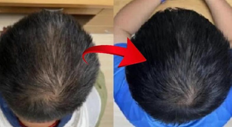 Saç yoğunluğu 2 ayda yüzde 25 arttı: Kelliğin çaresi bu serum mu? İşte gerçek