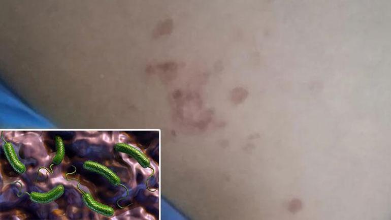 Serinlemek için girdi, yanıkla çıktı! Denizde enfeksiyon paniği: 'Buradan vücuda giriyor'