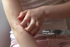 Süt Alerjisi Belirtileri Nelerdir? Süt Alerjisi Nasıl Anlaşılır? Tedavi Yöntemleri Nelerdir?