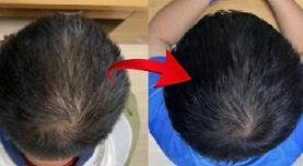 Saç yoğunluğu 2 ayda yüzde 25 arttı: Kelliğin çaresi bu serum mu? İşte gerçek